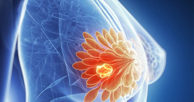 Tumori al seno: scoperta nuova proteina per migliorare terapie