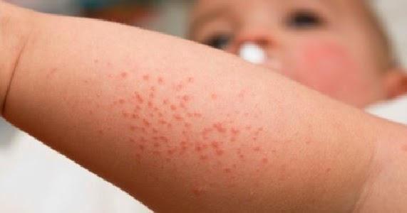 Dermatite atopica: fino all’8% degli italiani ne è colpito