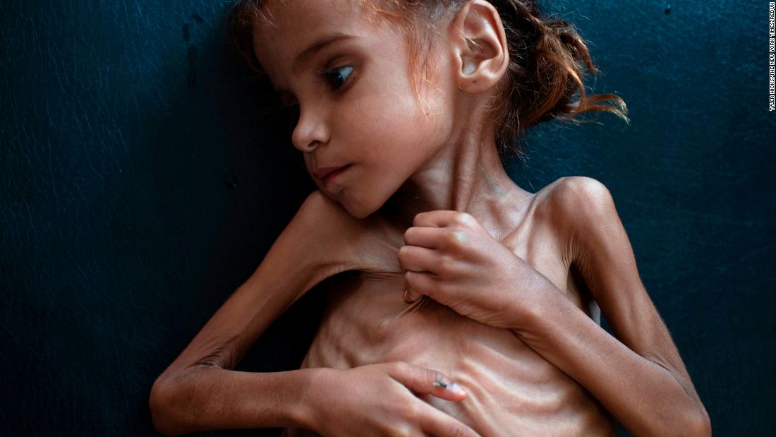 Starving girl who became symbol of Yemen crisis dies