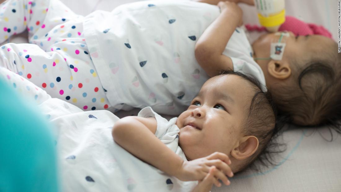 Even after separation, Bhutanese conjoined twins want to be close