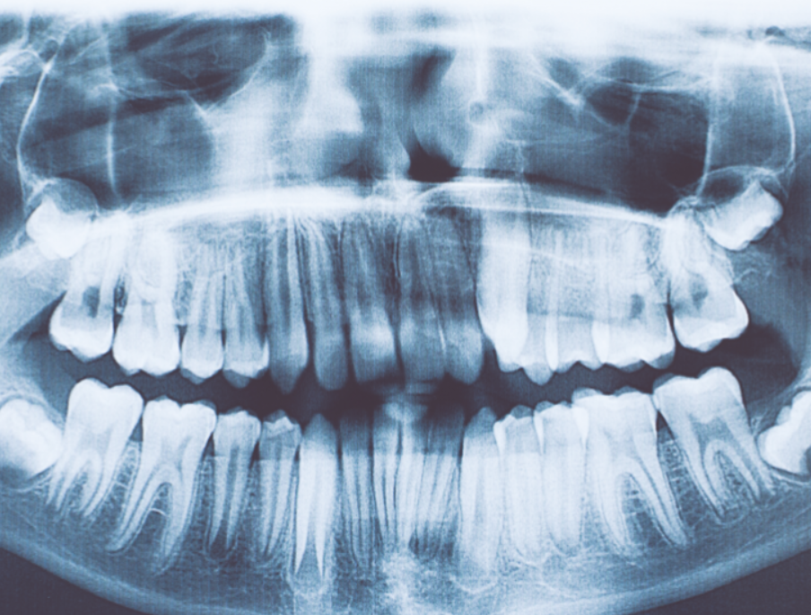Dentisti estraggono oltre 500 denti dalla bocca di un bambino di 7 anni