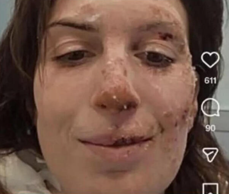 Rogo al Constellation di Crans-Montana: Eleonora Palmieri mostra le ustioni sul volto